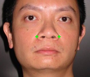 face photo nose flap landmarks